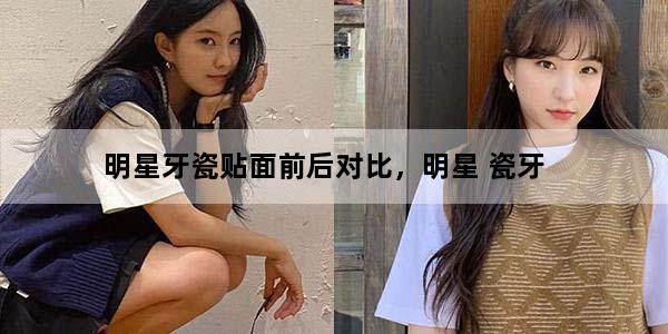 明星牙瓷贴面前后对比，明星 瓷牙